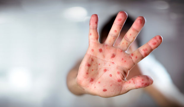 Flambée des cas de rougeole dans le monde : Le Maroc épargné grâce à la vaccination