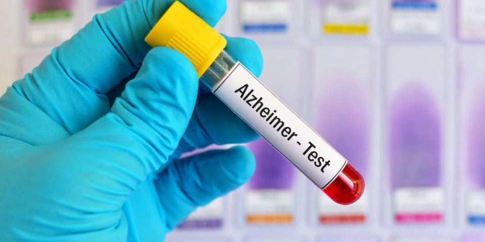 Un test sanguin pour dépister Alzheimer autorisé au Japon