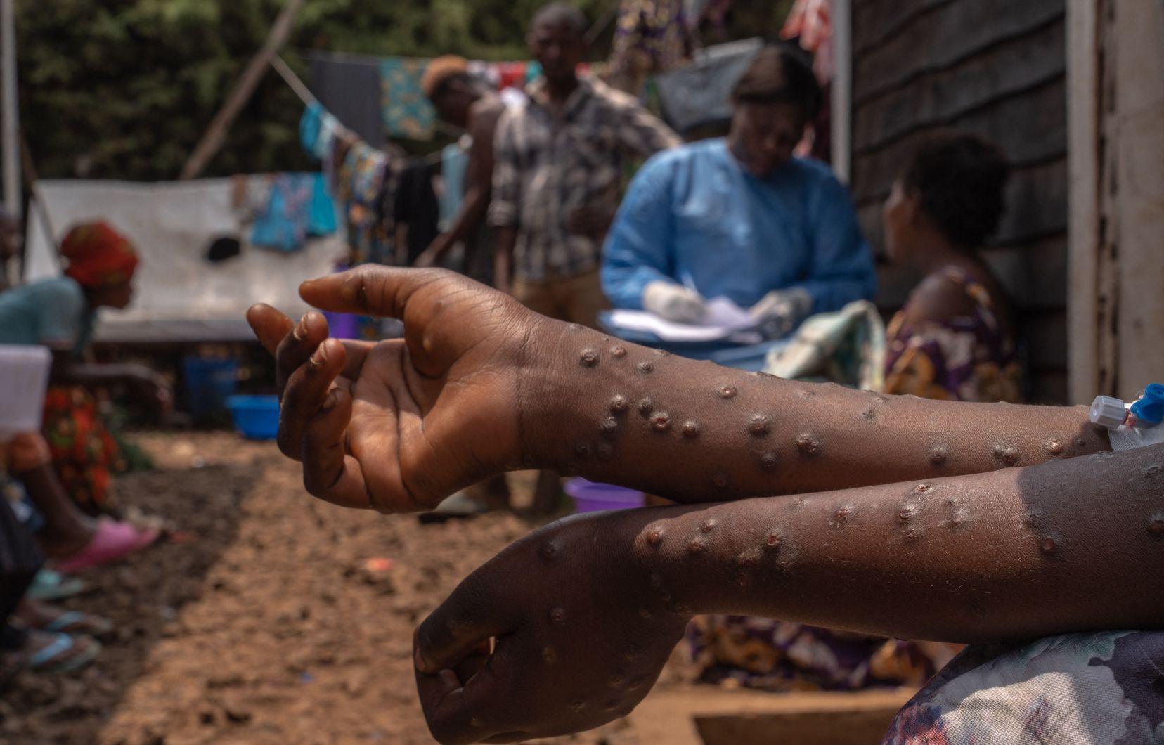 Mpox: plus de 2.700 nouveaux cas enregistrés en une semaine