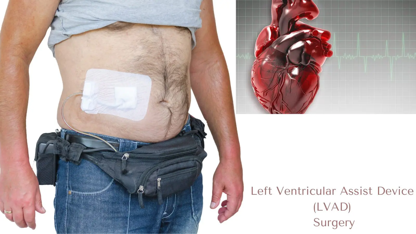 Insuffisance cardiaque avancée : Vicenne soutient l’implantation réussie d’un dispositif LVAD au Maroc